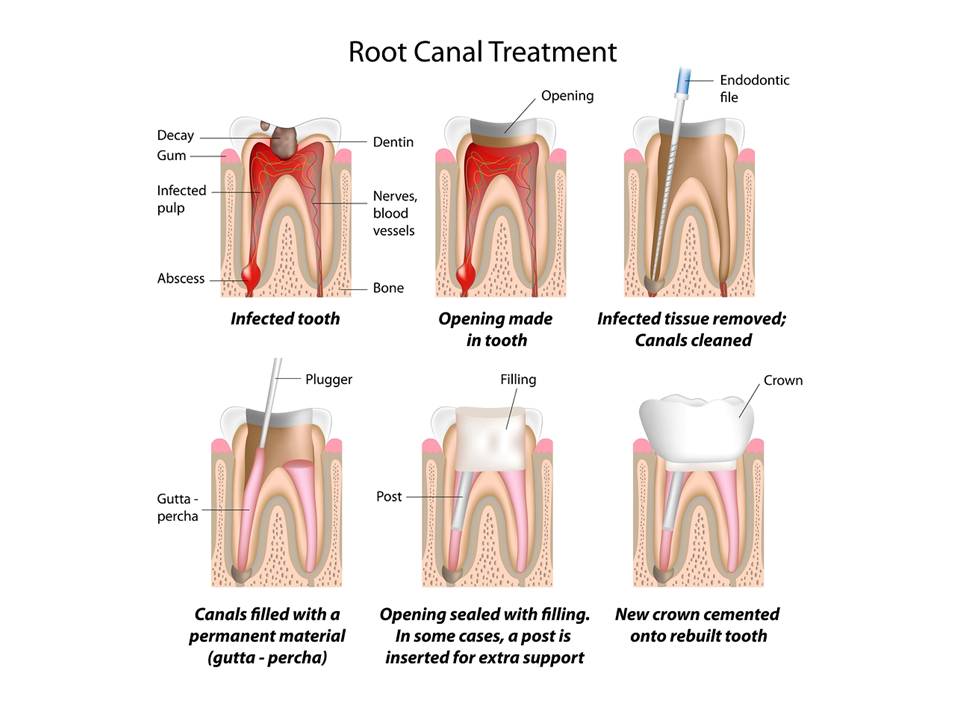 Root Canal | Family Dentistry in Santa Cruz, Calif.